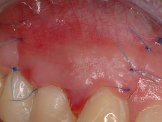 découvrez notre gel innovant pour la régénération osseuse, une solution avancée conçue pour favoriser la guérison et la reconstruction des tissus osseux. idéal pour les fractures et les interventions chirurgicales, ce gel unique stimule la régénération naturelle, améliorant ainsi le temps de récupération. optez pour une approche moderne et efficace pour votre santé osseuse.